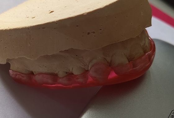محافظ تثبیت قوس فک بالا اکریلیک سخت برای دندان قروچه