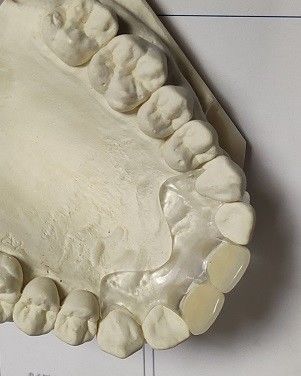 پروتز نامرئی نرم و راحت Fit ISO13485 RPD