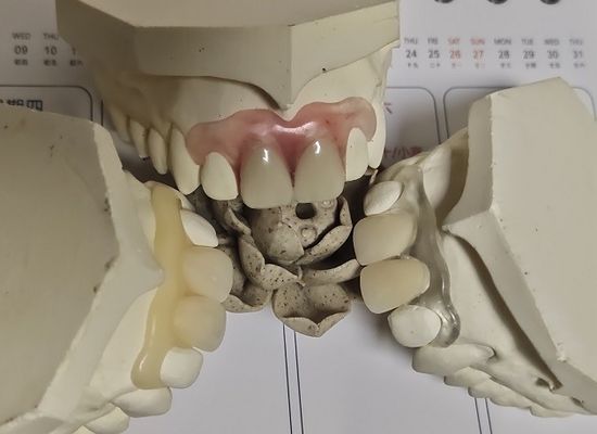 پروتز نامرئی نرم و راحت Fit ISO13485 RPD