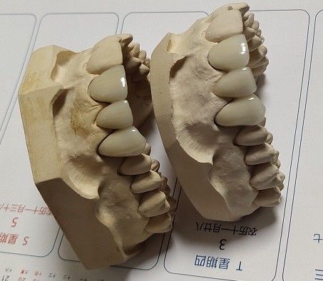 Crown Porcelain CAD CAM PFM