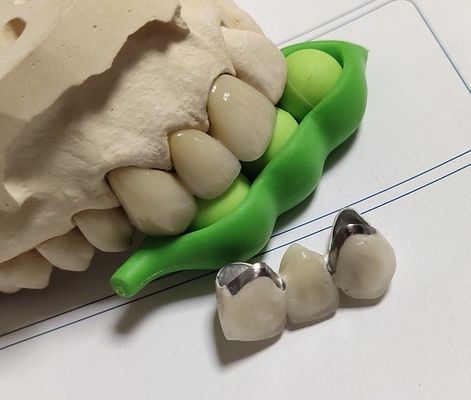 Crown Porcelain CAD CAM PFM