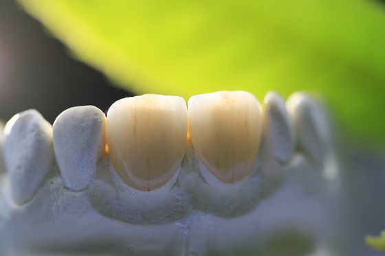 3D Print Framework PFM Dental Lab Crown For Dentistry