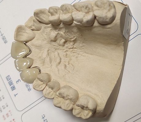تاج دندانی Metal Ceramic Good Fitness PFM
